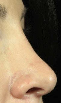 Fillers. Before Treatment photos - female, right side view, patient 24
