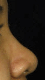 Fillers. Before Treatment photos - female, right side view, patient 25
