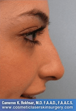 Fillers. After Treatment photos - female, right side view, patient 27