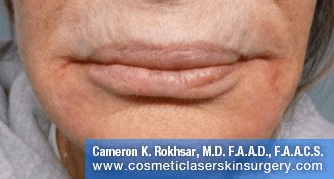 Fillers. After Treatment photos - female, front view, patient 4