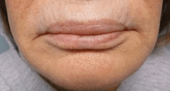 Fillers. Before Treatment photos - female, front view, patient 4