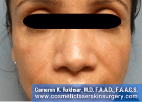 Fillers. After Treatment photos - front view, female patient 30