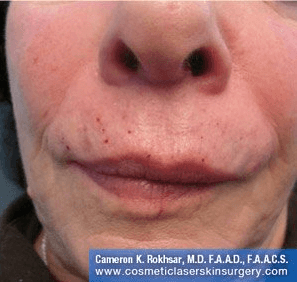 Fillers. After Treatment photos - female, front view, patient 9