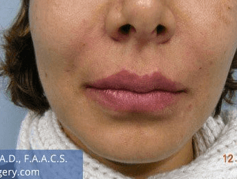 Fillers. After Treatment photos - female, front view, patient 8