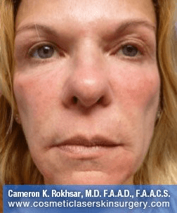 Fillers. After Treatment photos - female, front view, patient 5