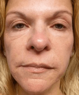 Fillers. Before Treatment photos - female, front view, patient 5