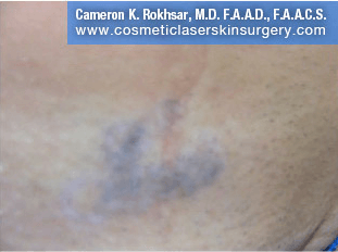 Tattoo Removal - After Treatment photo, patient 3