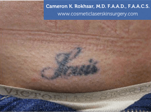 Tattoo Removal - Before Treatment photo, patient 3