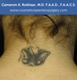 Tattoo Removal - Before treatment photo, female (neck),back side view, patient 3