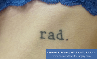 Tattoo Removal - Before Treatment photo, patient 4