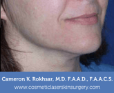 Ultherapy - After treatment photo, female right side oblique view, patient 2