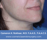 Ultherapy - Before treatment photo, female right side oblique view, patient 2