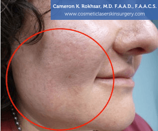 V-Beam Laser Before Treatment Photo - patient 2
