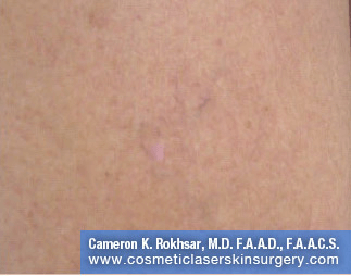 Sclerotherapy After Treatment Photo - patient 2