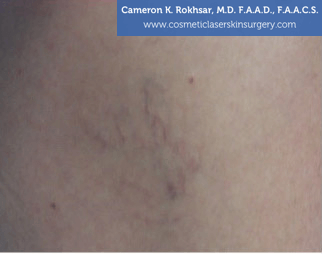 Sclerotherapy Before Treatment Photo - patient 2
