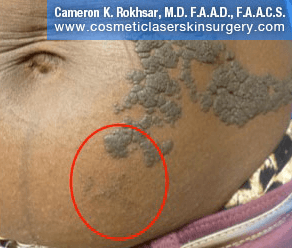 Birthmark Removal Gallery - After Treatment Photo - patient 4