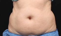 CoolSculpting. Before Treatment photo, female - front view, patient 3