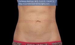 CoolSculpting. After Treatment photo, female - front view, patient 2