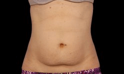 CoolSculpting. Before Treatment photo, female - front view, patient 2