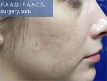 Microneedling. After Treatment Photos - female, right side view, patient 1