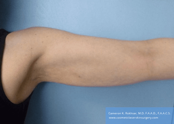 Liposculpture Liposuction - After Treatment photos, front view, female hand, patient 24