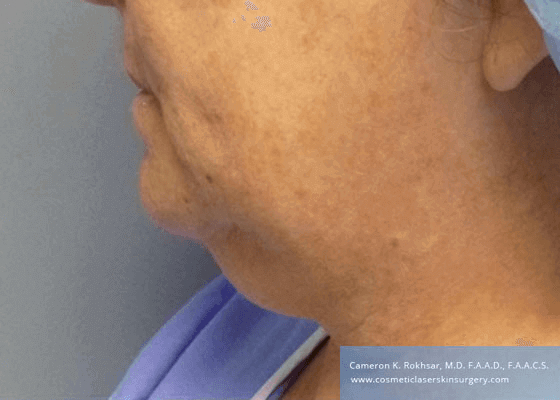 Liposculpture Liposuction - Before Treatment photos, left side view, female, patient 25