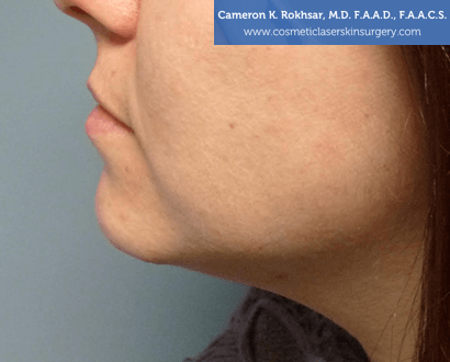Non-Surgical Chin Job - After Treatment photo, female - left side view, patient 3