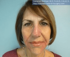 Non Surgical Nosejob - After treatment photo, female,front view, patient 15