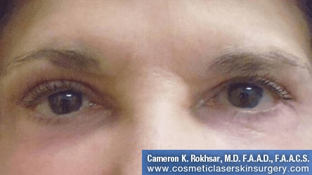 Non-Surgical Eye Lift - After Treatment Photo - front view, female patient 3