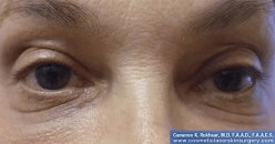 Non-Surgical Eye Lift - After Treatment Photo - female patient 2