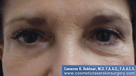 Non-Surgical Eye Lift - Before Treatment Photo - front view, female patient 3
