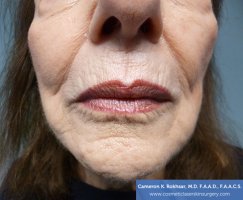 Fraxel and stretch marks - Before Treatment photo - patient 3