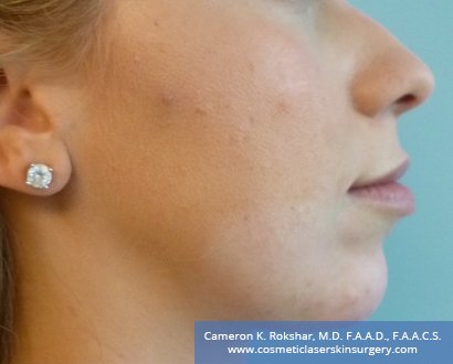 Non-Surgical Chin Job - After Treatment photo, female - right side view, patient 2