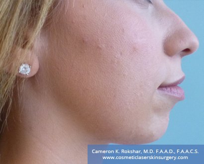 Non-Surgical Chin Job - Before Treatment photo, female - right side view, patient 2