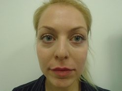 Lip Enhancement - After Treatment Photo, front view - female patient 3