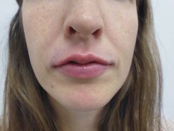 Lip Enhancement - After Treatment Photo, front view - female patient 4