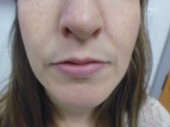 Lip Enhancement - Before Treatment Photo, front view - female patient 4