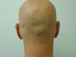 Male head, After Birthmarks Treatment - back view, patient 2