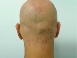 Male head, Before Birthmarks Treatment - back view, patient 2
