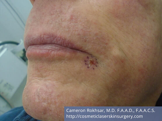 Mohs Surgery - After Treatment photo, left side, oblique view, male patient 4