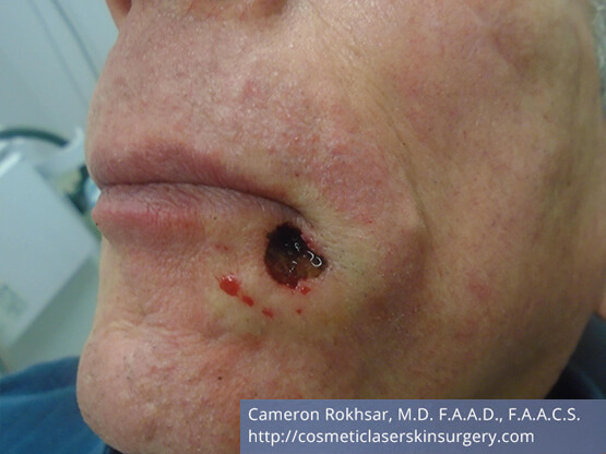 Mohs Surgery - Before Treatment photo, left side oblique view, male patient 4