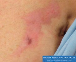 Fraxel and stretch marks - Before Treatment photo - patient 2