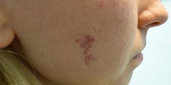 Female face, Before Birthmarks Treatment - right side view, patient 1