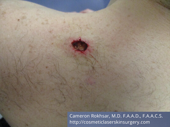 Male body, Before Mohs Surgery Treatment - patient 1