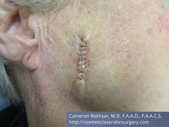 Mohs Surgery - Before Treatment photo, right side view,female patient 3