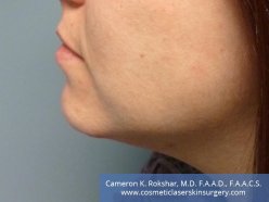 Kybella - After Treatment photo, left side view, 34 year old female with dramatic improvement of neck 