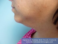 Kybella - Before Treatment photo, left side view, 34 year old female with dramatic improvement of neck 