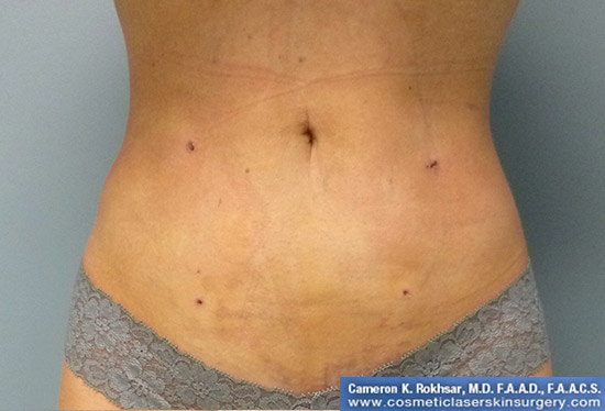 Liposuction - After Treatment Photo, front view - female patient 3