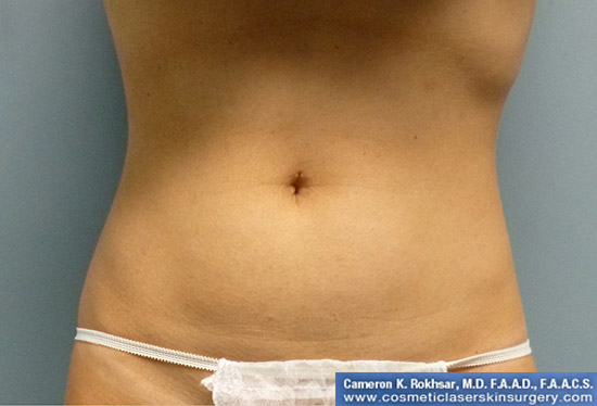 Liposuction - Before Treatment Photo, front view - female patient 3