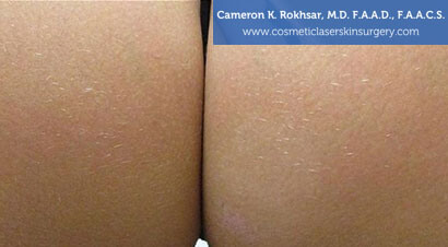 Birthmarks. After treatment photo -  buttock, patient 9